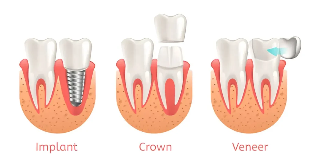 Veneers vs Crowns: Which One Will Give You the Perfect Smile?