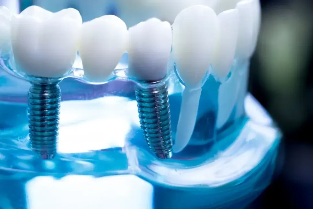 Dental Implants A Practical Guide to Restoring Your Smile