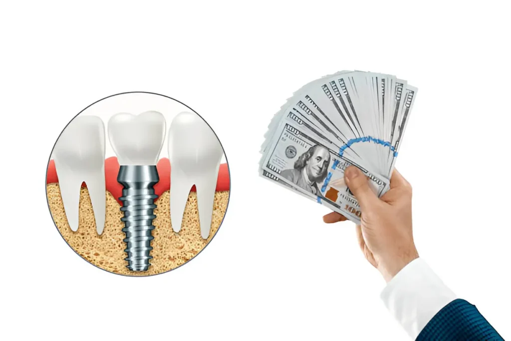 Cost vs. Value What to Know Before Getting Implants